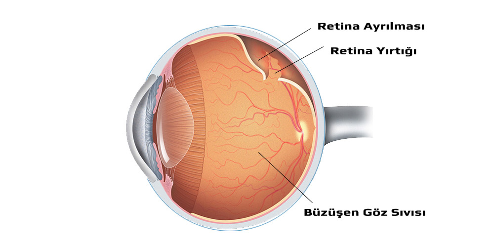 Retina Ayrılması